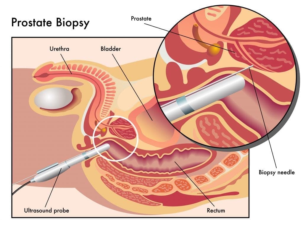 prostate-biopsy